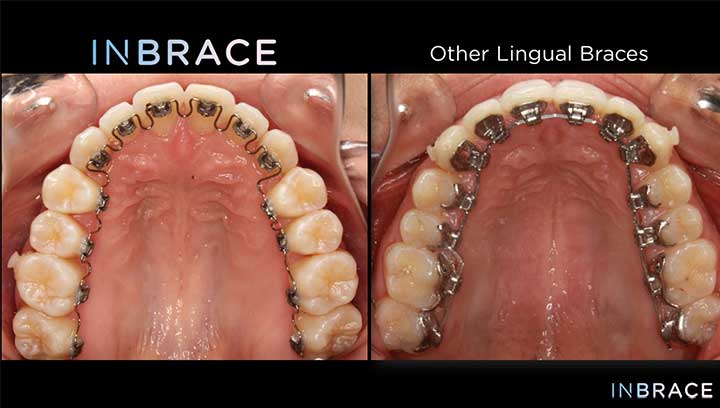 lingual braces